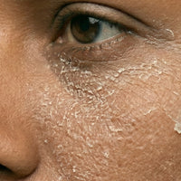 Dry Skin