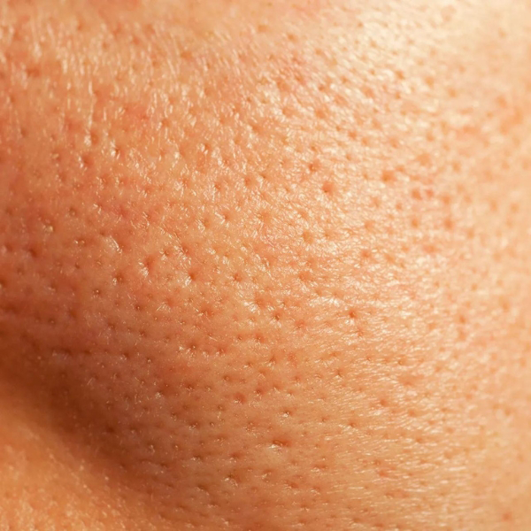Open Pores