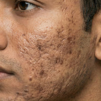 Dark Spots & Pigmentation