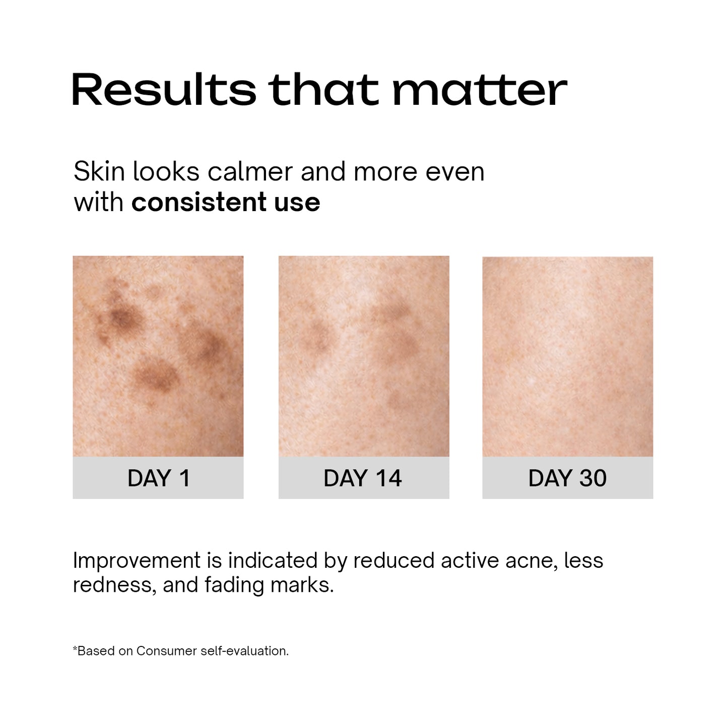 Azelaic Acid 9% GDL 5% Niacinamide 4% Cream