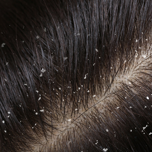 Dandruff