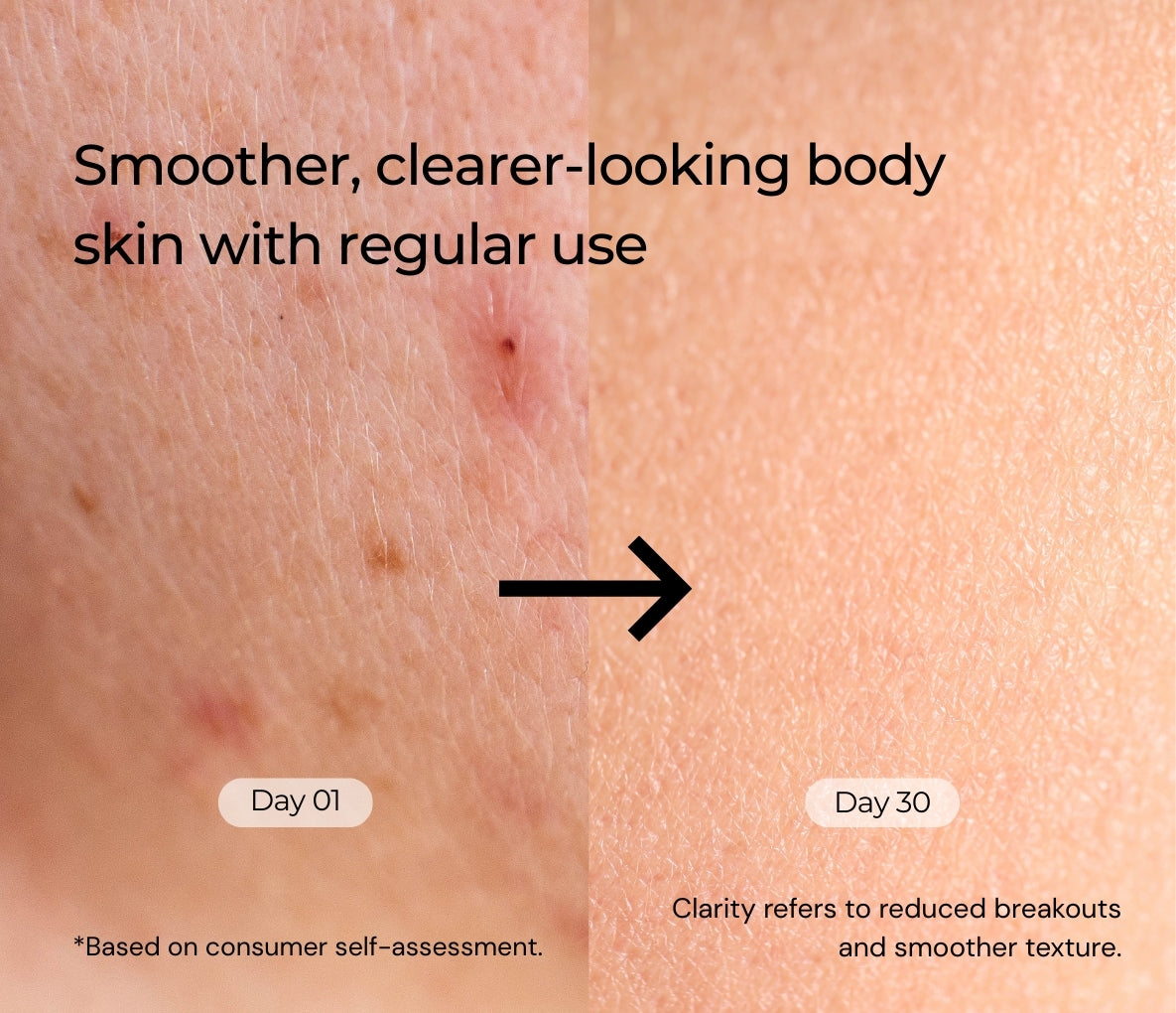 Acne Free Body Moisturizer