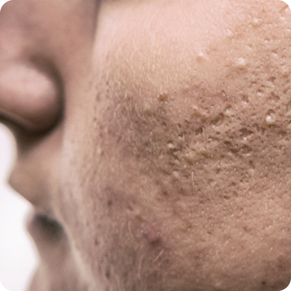 Acne Scars