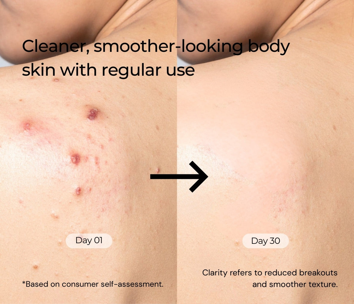 2% Salicylic Acid Acne Free Body Wash