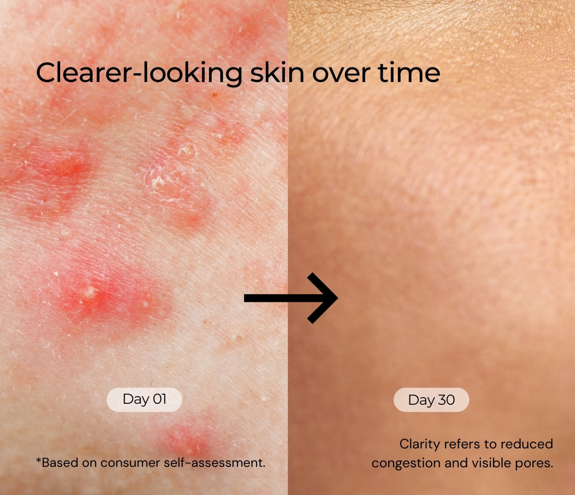 Salicylic Acid 2% Betaine 3% Serum